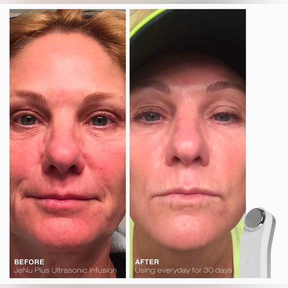 NEW Trophy Skin JeNu Plus Ultrasonic Infuser plus 1 oz Microsphere Infusion Gel - Picture 5 of 7